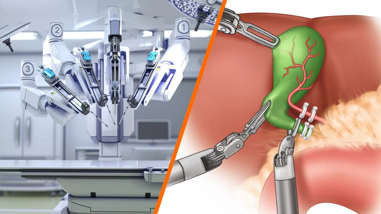 Robotic gallbladder surgery in Dwarka west delhi
